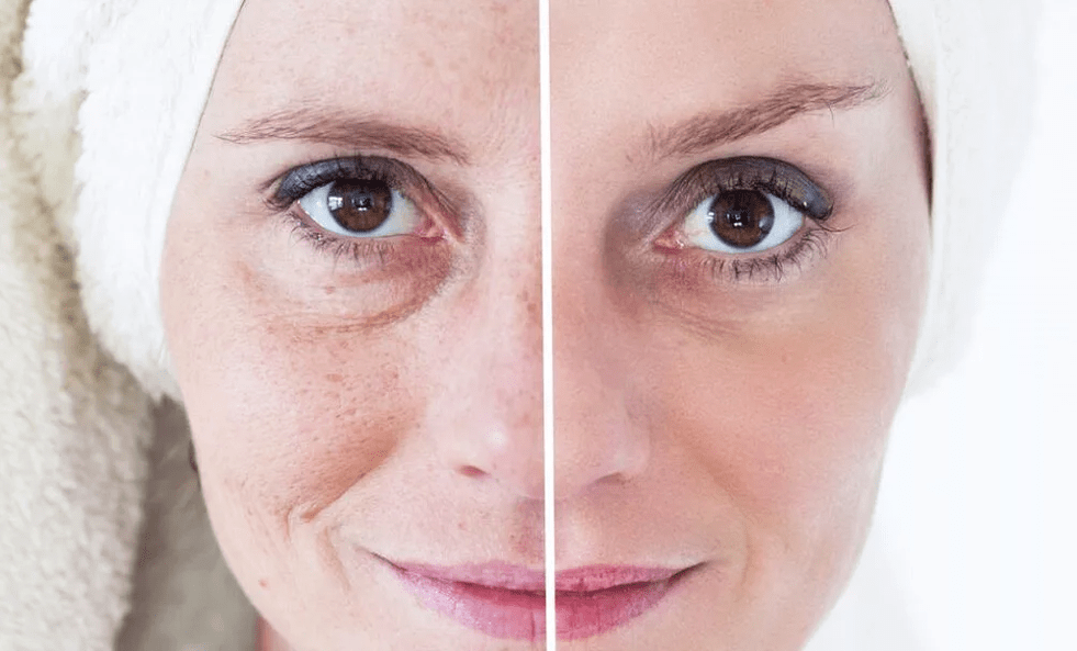 laserové omlazení obličeje